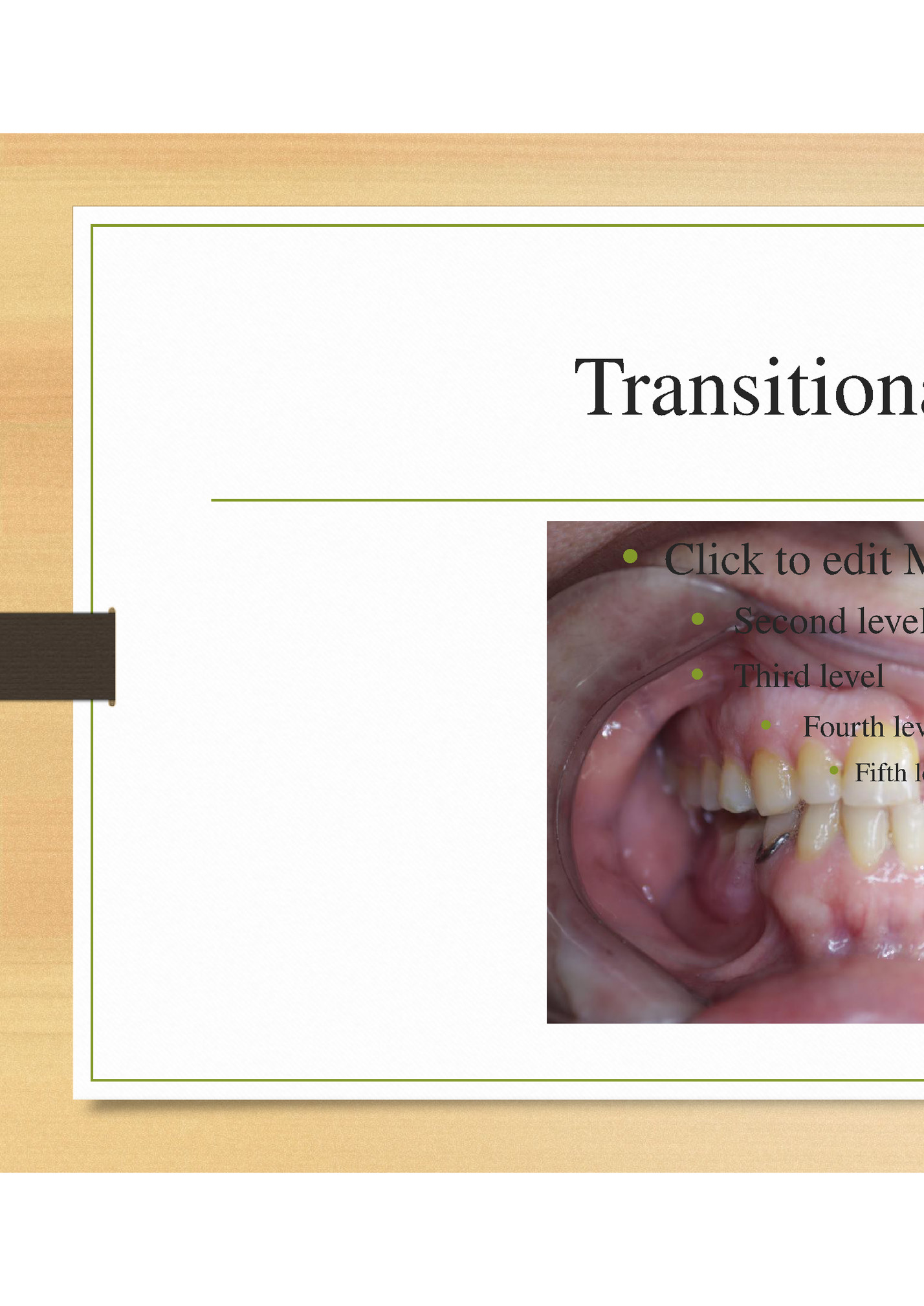 Transitional Denture