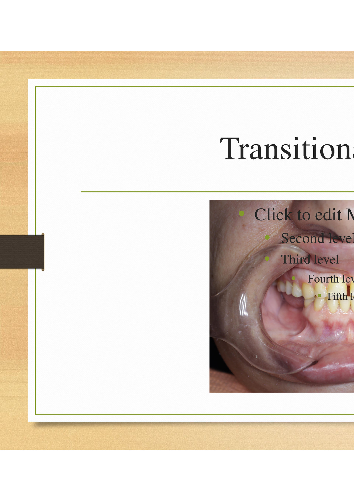 Transitional Denture