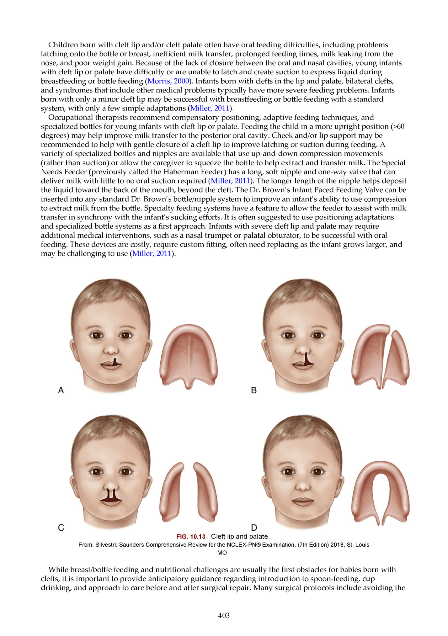 Children born with cleft lip and/or cleft palate often have oral feeding diﬃculties, including problems