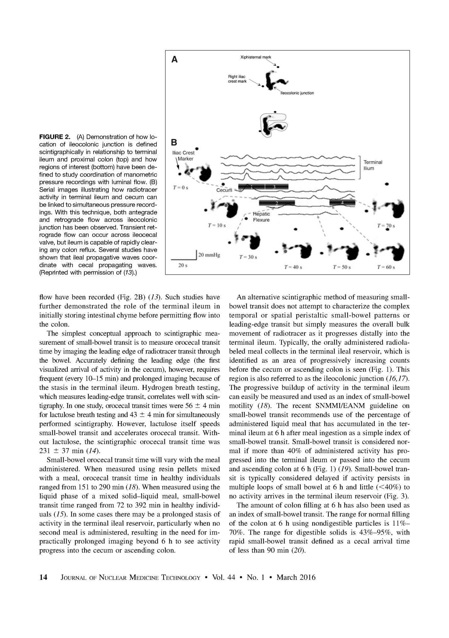 FIGURE 2. (A) Demonstration of how location of ileocolonic junction is deﬁned